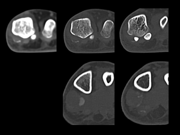 Figure 4 for case calcium hydroxyapatite crystal deposition disease ( RID3594 )